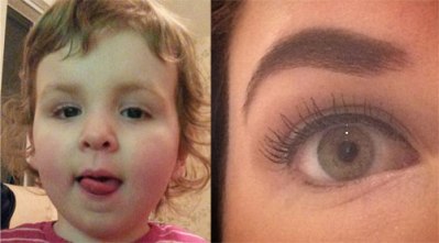 A toddler with aniridia and and adult without